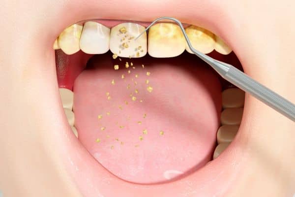 Primer plano de sarro dental siendo eliminado para prevenir inflamación y deterioro cognitivo.